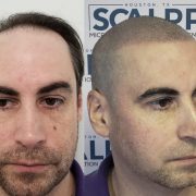 Scalpp Clinic : Scalp Micropigmentation Houston
